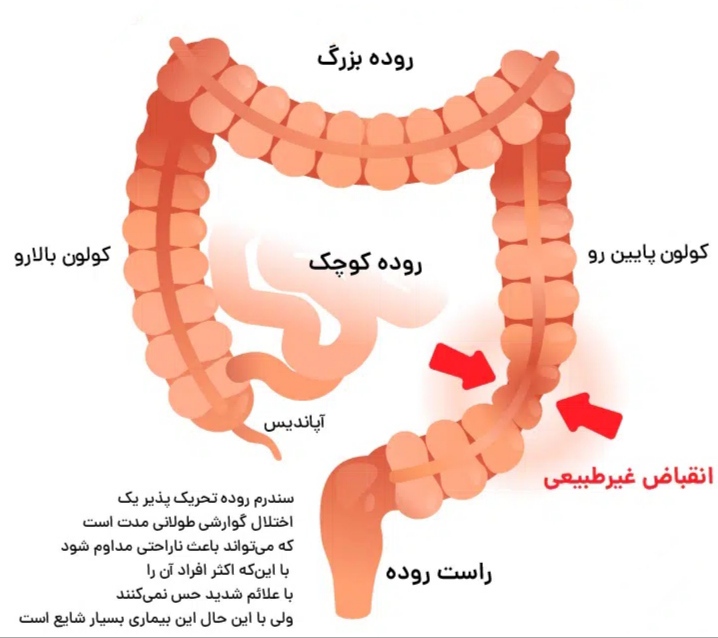 سندروم روده تحریک پذیر