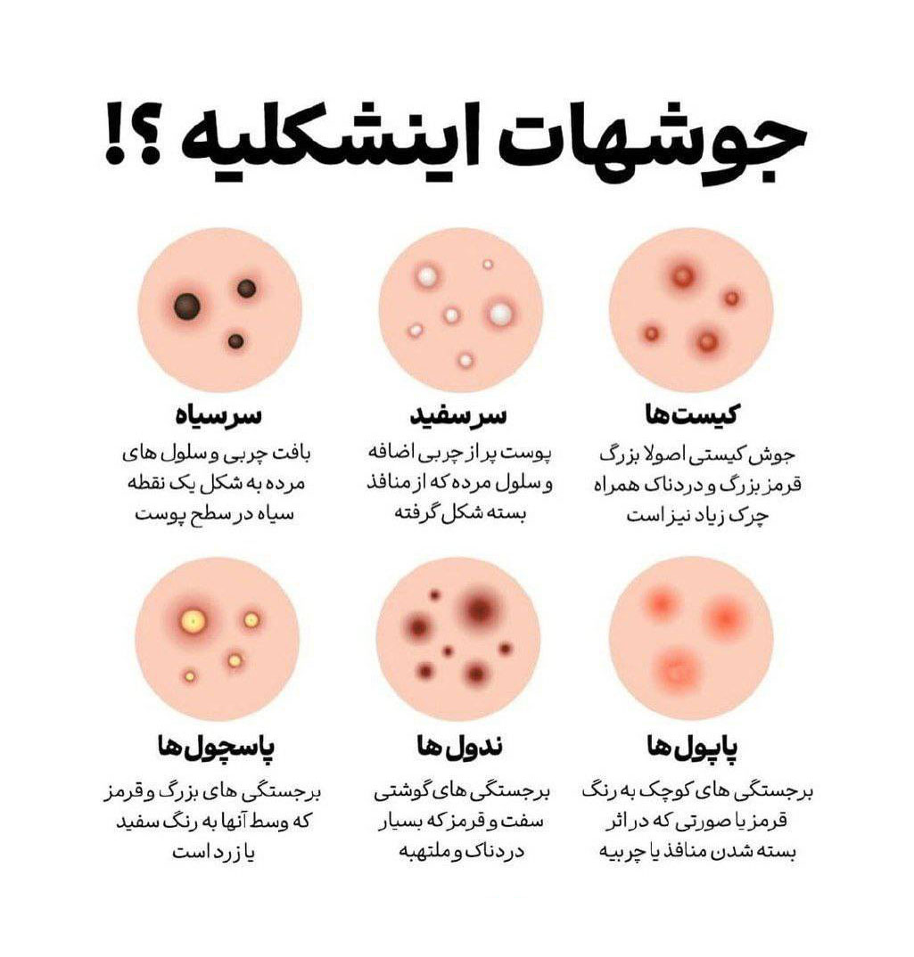 انواع جوش و علت های آن