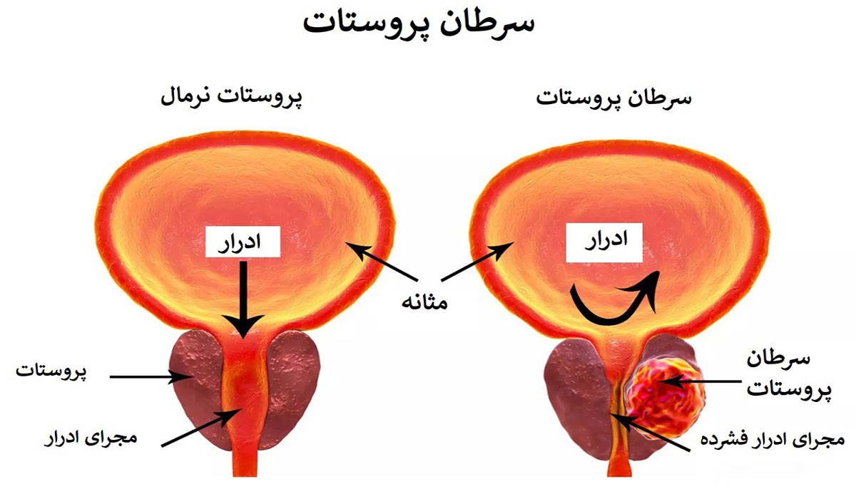 پروستات نرمال (سمت چپ) و سرطان پروستات (سمت راست)
