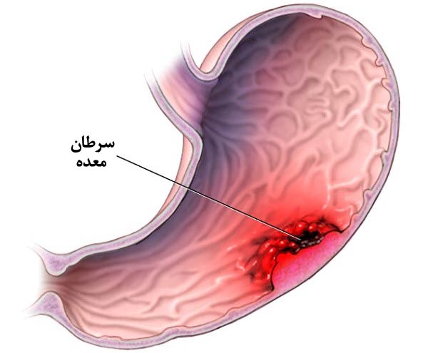 سرطان معده