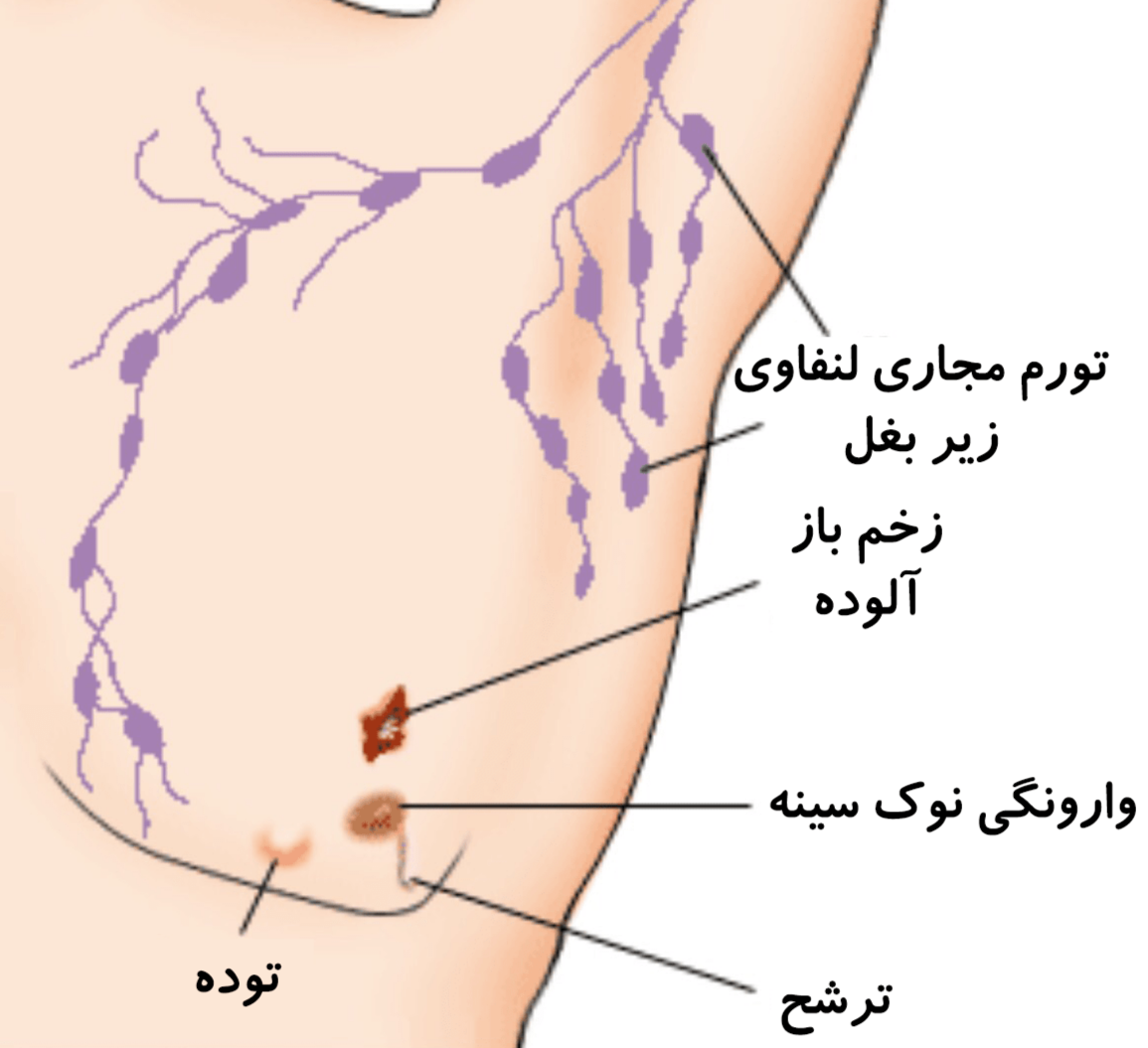 علائم سرطان سینه در مردان