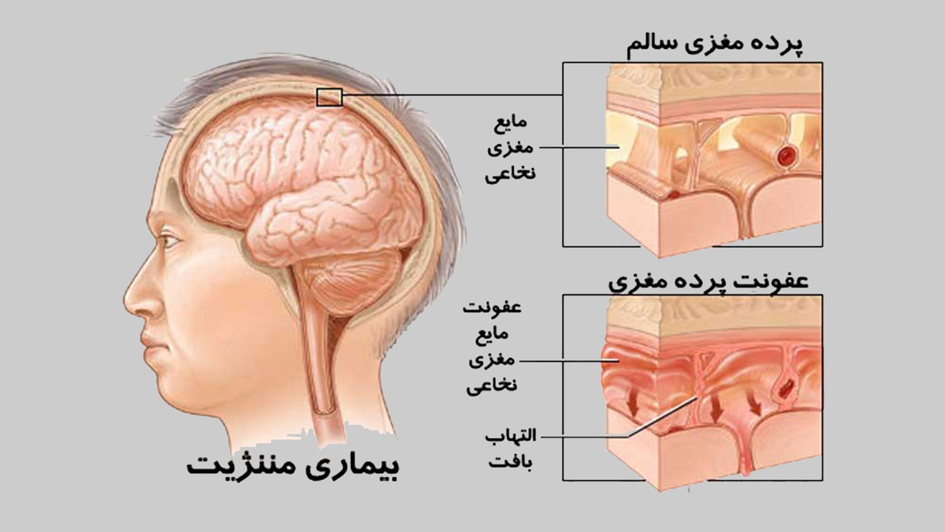 مننژیت