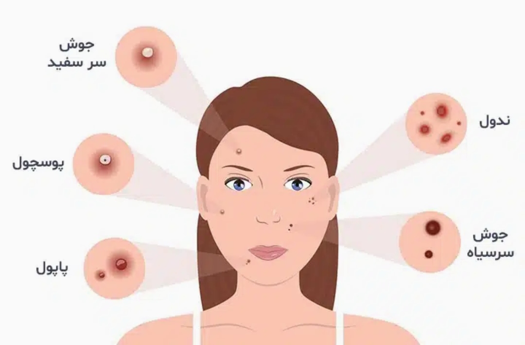 انواع آکنه بر روی پوست