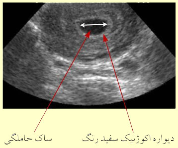 تصاویر یک سونوگرافی که در آن ساک حاملگی مشخص شده است.