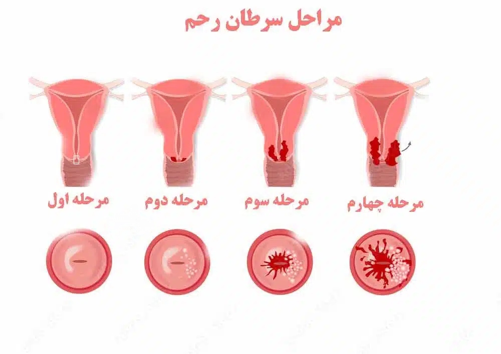 سرطان رحم