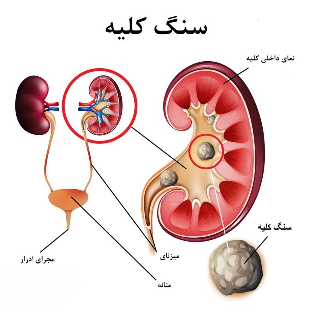سنگ کلیه