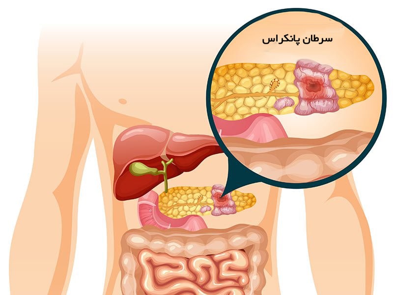 سرطان پانکراس