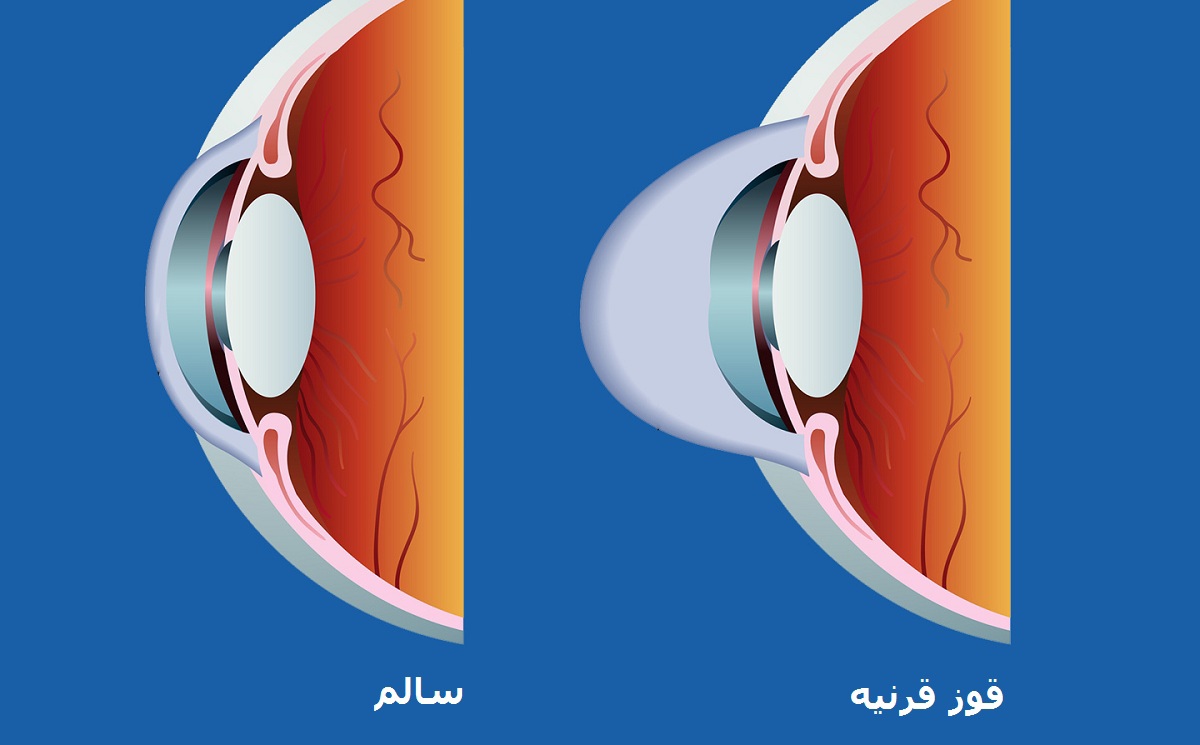 تصویری از چشم سالم و چشم مبتلا به قوز قرنیه