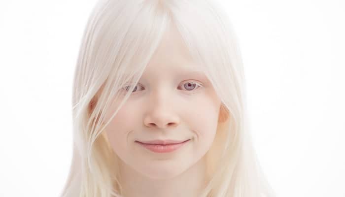 یک فرد مبتلا به آلبینیسم