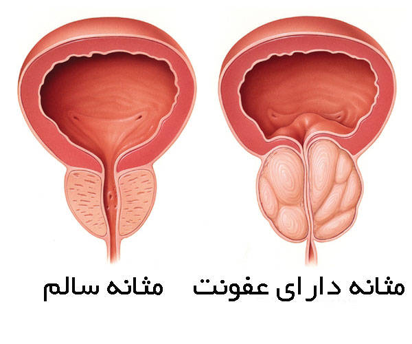تفاوت مثانه یک فرد سالم با مثانه فردی که دچار عفونت مثانه است