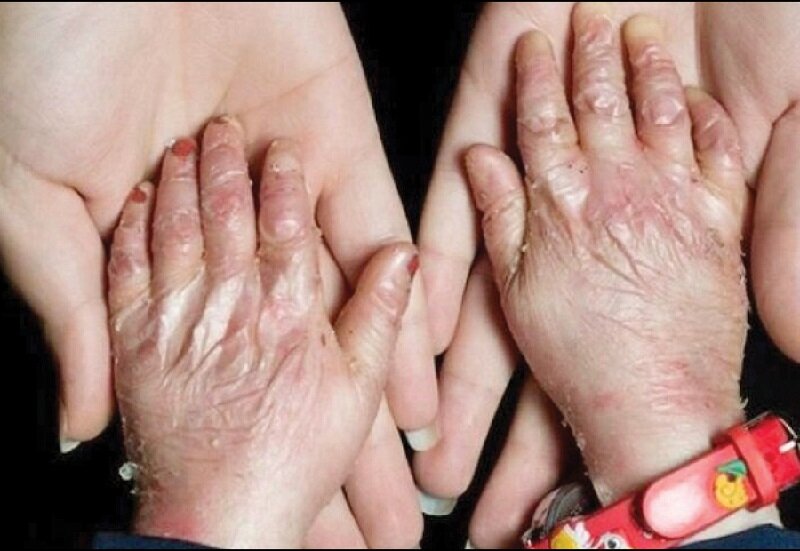 <strong>دست یک فرد مبتلا به بیماری پروانه ای</strong>