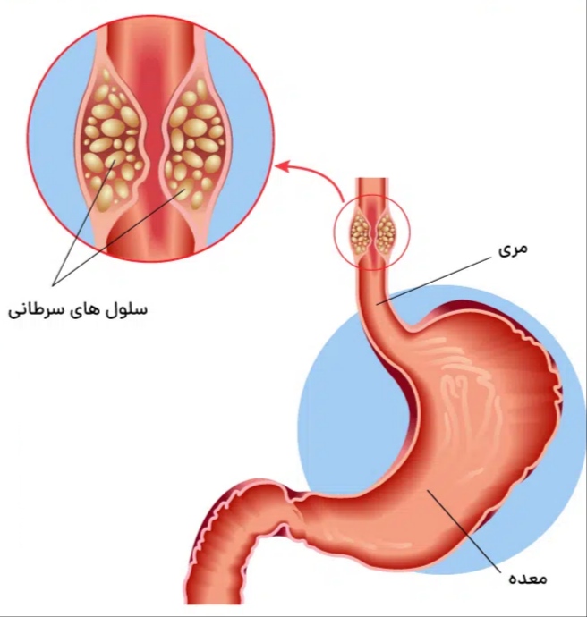 سرطان مری