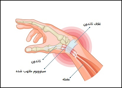 جایگاه تاندون در دست