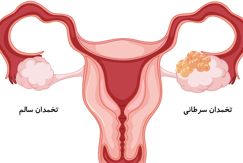 تفاوت تخمدان سرطانی با یک تخمدان سالم