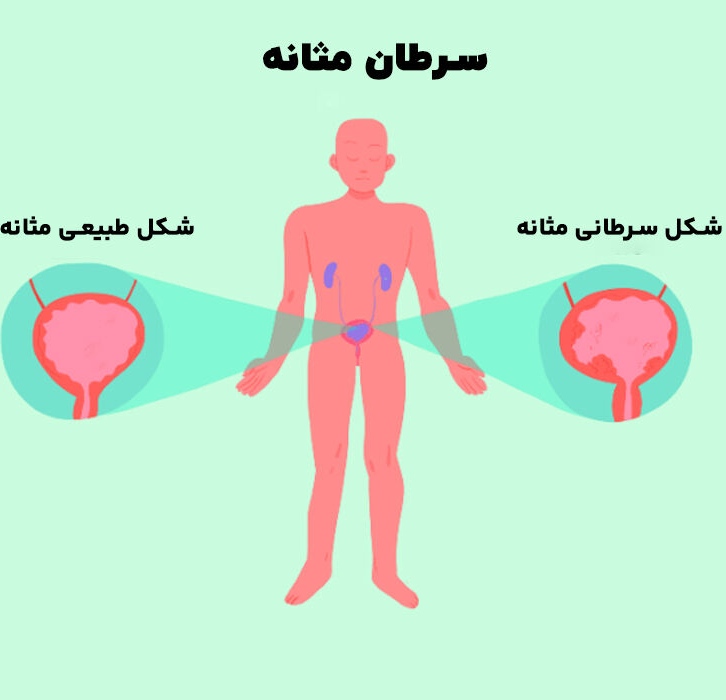تفاوت شکل مثانه در حالت طبیعی و سرطانی