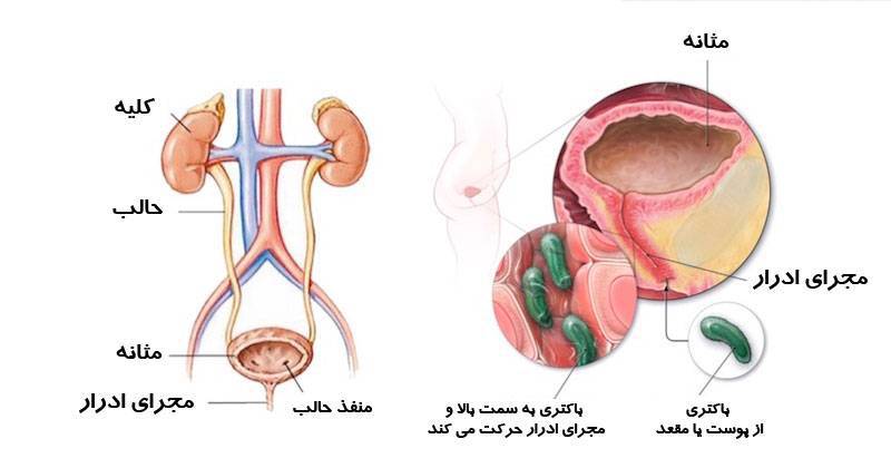 عفونت ادراری