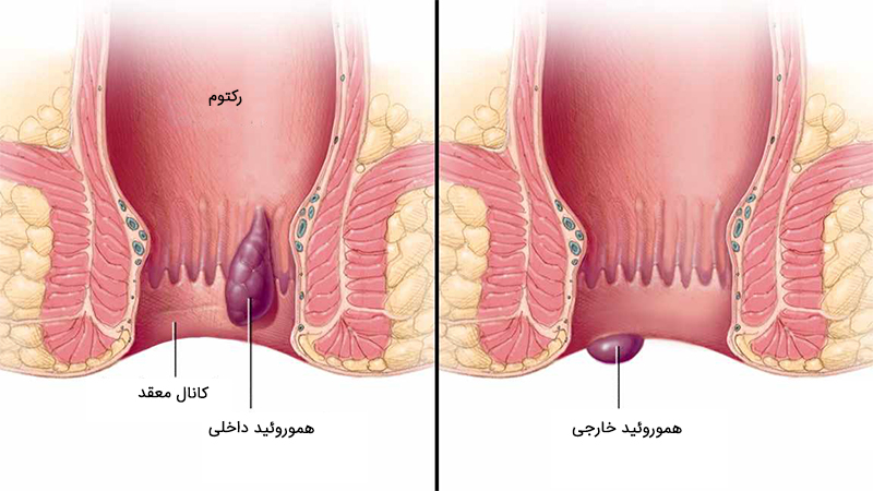 تصویر دو نوع بواسیر؛ سمت راست: بواسیر(هموروئید) خارجی و سمت چپ: بواسیر(هموروئید) ترومبوز