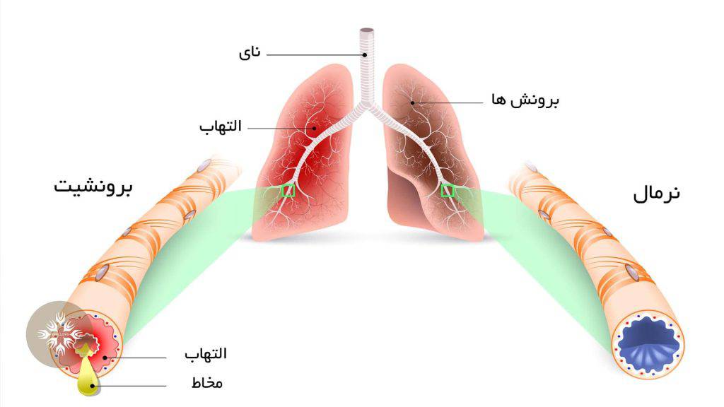 تصویری از برونش ها در حالت نرمال (سمت راست) و مبتلا به برونشیت (سمت چپ)