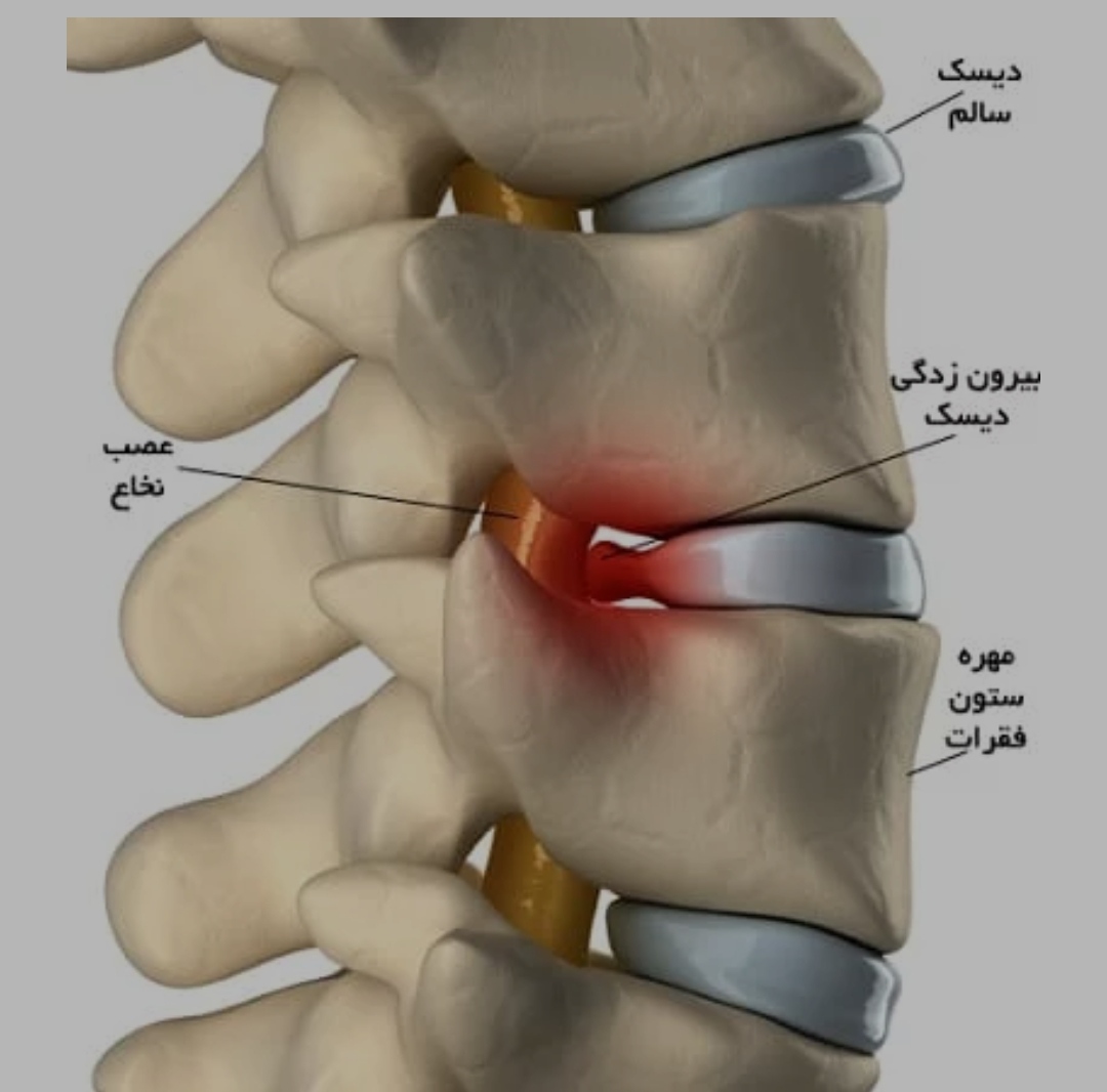 تصویری از دیسک گردن