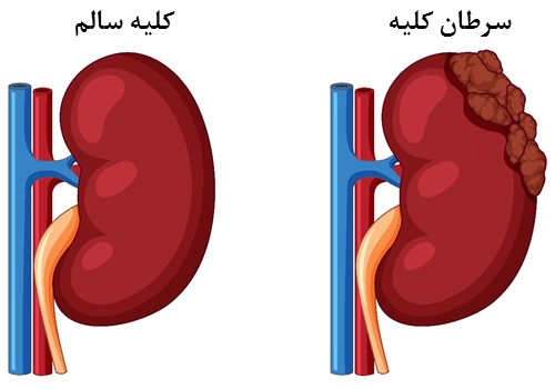 تفاوت کلیه سالم با کلیه‌ای که درگیر سرطان می‌باشد.