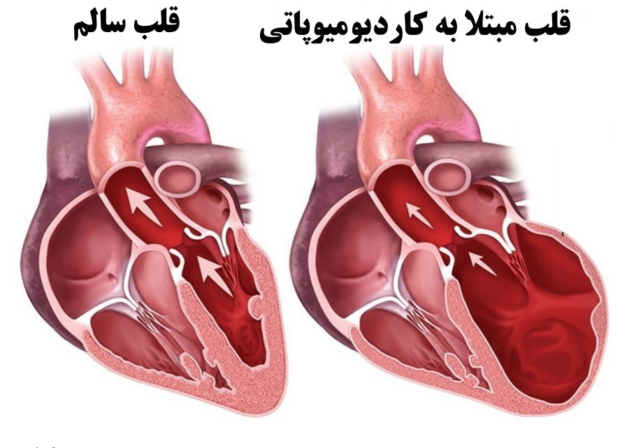 کاردیومیوپاتی هیپرتروفیک