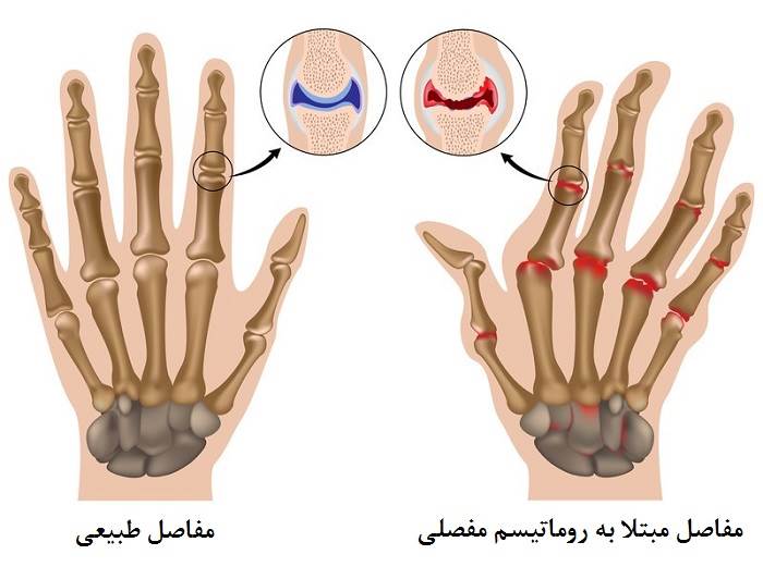 روماتیسم مفصلی