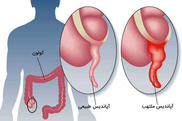 تصویری از محل قرارگیری آپاندیس و مقایسه آپاندیس سالم و آپاندیسیت