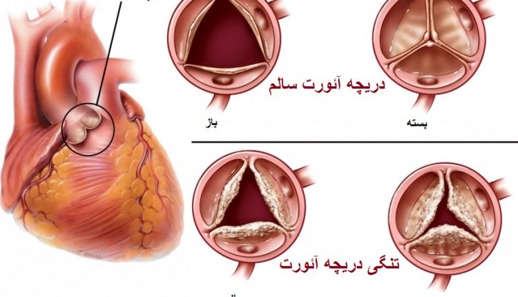 تنگی دریچه آئورت