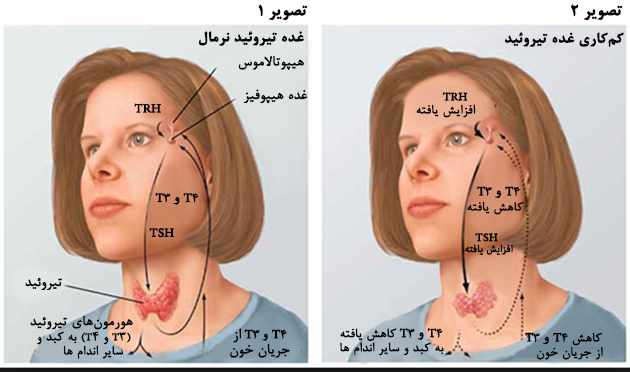 مقایسه تیروئید کم‌کار (سمت راست) با تیروئید نرمال (سمت چپ)