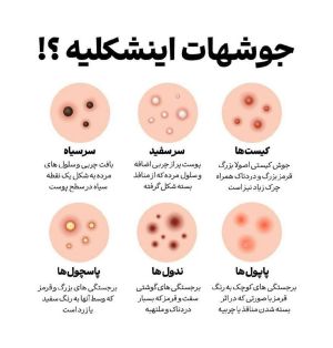 انواع جوش و علت های آن