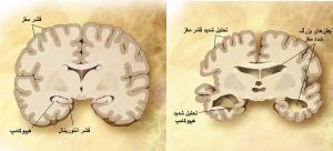 تغییرات مغز در زوال عقل (تصویر مغز سمت راست) نسبت به مغز سالم (تصویر مغز سمت چپ)