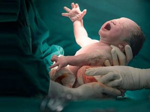 تصویر از یک نوزاد تازه متولد شده در اتاق عمل.jpg