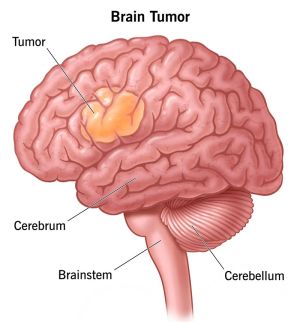 تومور مغزی .jpg