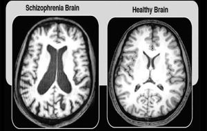 تصویری از تفاوت در مغز بیمار مبتلا به اسکیزوفرنی (سمت چپ) در مقابل مغز یک فرد سالم (سمت راست)