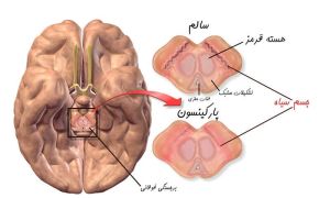 تغییرات مغز در بیماری پارکینسون