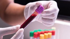 نمونه خون در لوله آزمایشگاهی برای انجام آزمایش‌های مختلف