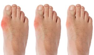 شایع‌ترین شکل ظهور نقرس در بدن، در انگشتان پا است