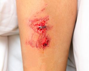 تصویری از زخم باز بر روی پوست
