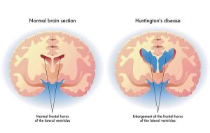 تغییرات مغز در بیماری هانتینگتون