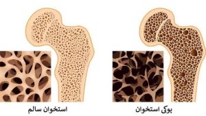 مقایسه استخوان سالم و پوکی استخوان