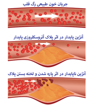 مقایسه‌ی جریان خون طبیعی، آنژین پایدار و آنژین ناپایدار .png