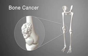 بروز سرطان استخوان در پا.jpg