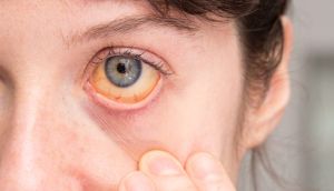 زردی درون چشم یکی از نشانه‌های بیماری یرقان.jpg