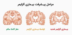 در مراحل پیشرفت آلزایمر، شاهد تحلیل شدید قشر مغز و هیپوکامپ می‌باشیم..jpg