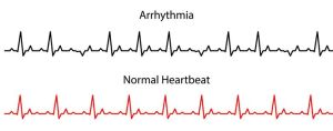 آریتمی اختلال در ریتم طبیعی ضربان قلب است.